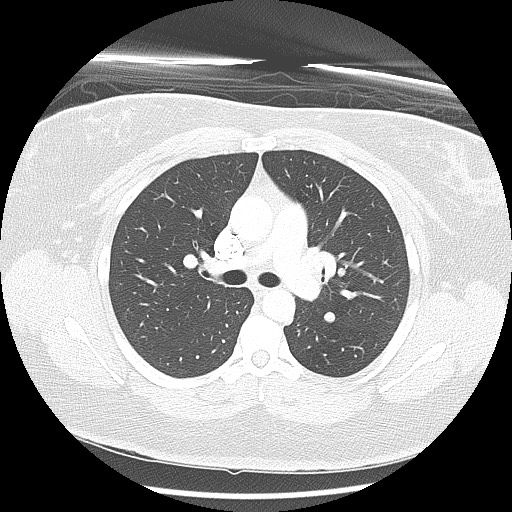 Alveolar soft part sarcoma - right leg (Radiopaedia 59432-67091 Axial lung window 44).jpg