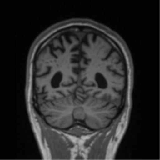 Alzheimer's disease- with Gerstmann syndrome and dressing apraxia (Radiopaedia 54882-61150 Coronal T1 23).png
