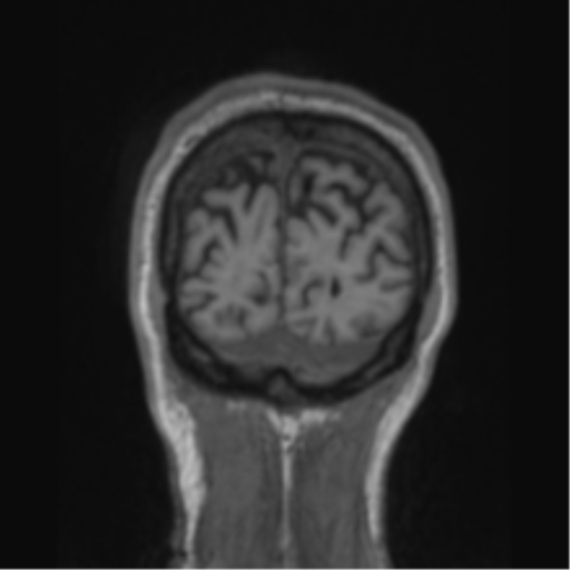 File:Alzheimer's disease- with apraxia (Radiopaedia 54763-61011 Coronal T1 15).png