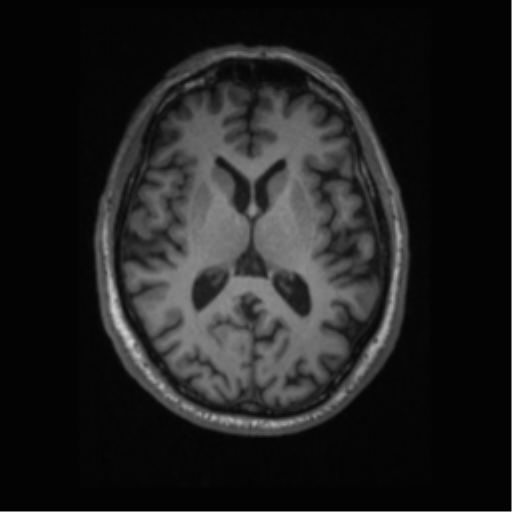 Alzheimer disease - probable (Radiopaedia 35334-36837 Axial T1 42).png