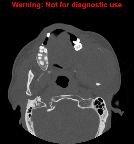 File:Ameloblastoma (Radiopaedia 13276-13280 Axial non-contrast 16).jpg