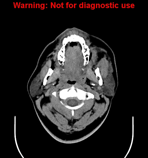 File:Ameloblastoma (Radiopaedia 33126-34164 A 2).jpg