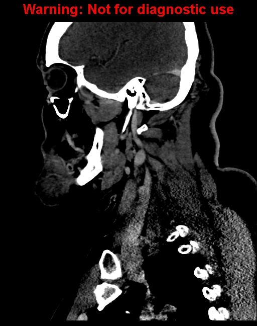 Ameloblastoma (Radiopaedia 33126-34164 F 50).jpg