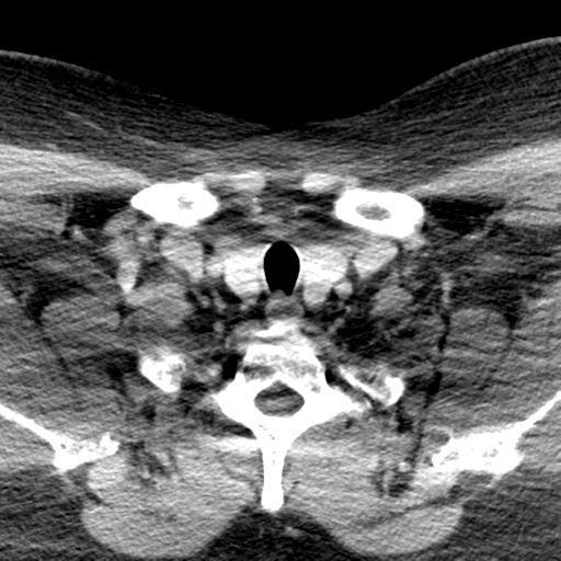 Ameloblastoma (Radiopaedia 38520-40623 Axial non-contrast 70).png