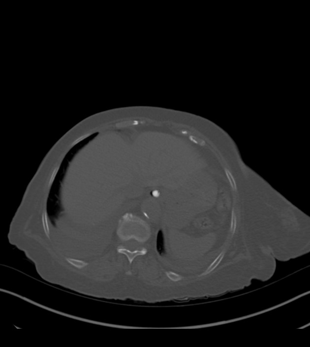 Amiodarone deposition in the liver (Radiopaedia 77587-89780 Axial bone window 70).jpg