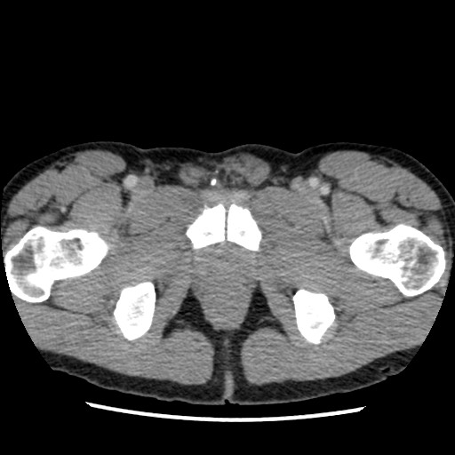 Amoebic liver abscesses (Radiopaedia 55536-62009 A 91).jpg