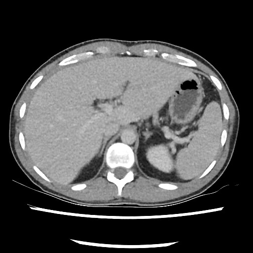 Amoebic liver abscesses (Radiopaedia 55536-62010 A 25).jpg
