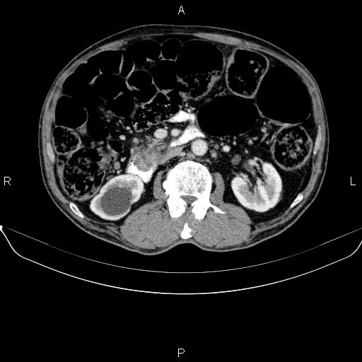 File:Ampullary adenocarcinoma (Radiopaedia 86093-102032 A 27).jpg