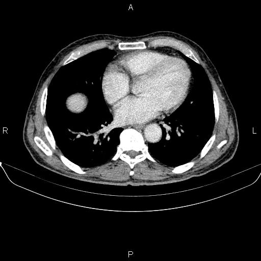 File:Ampullary adenocarcinoma (Radiopaedia 86093-102032 A 4).jpg