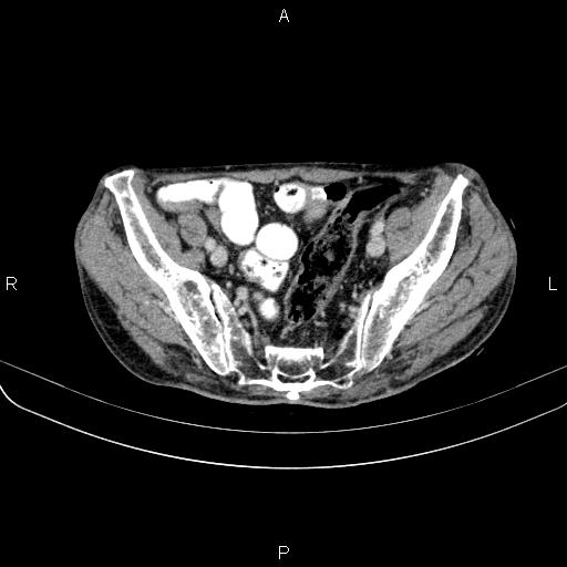 Ampullary adenocarcinoma (Radiopaedia 86093-102033 B 97).jpg