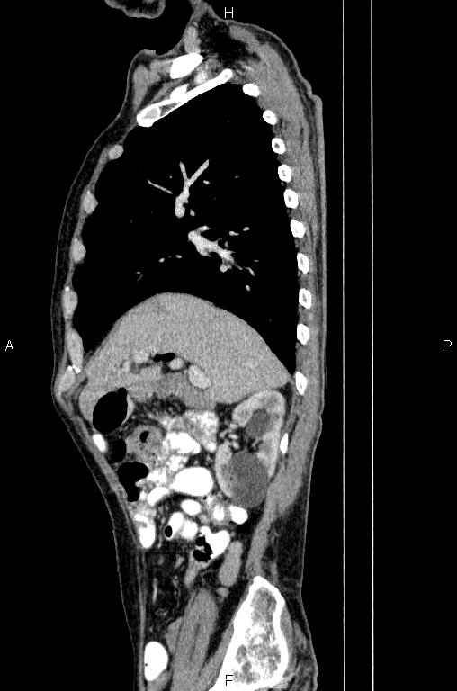 Ampullary adenocarcinoma (Radiopaedia 86093-102033 E 28).jpg