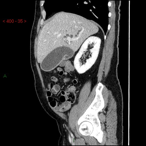 Ampullary carcinoma (Radiopaedia 56396-63056 D 34).jpg