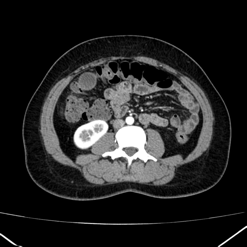 Ampullary tumor (Radiopaedia 22787-22816 B 50).jpg