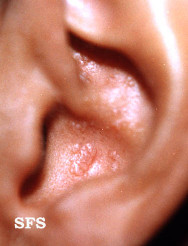 File:Amyloidosis (Dermatology Atlas 1).jpg