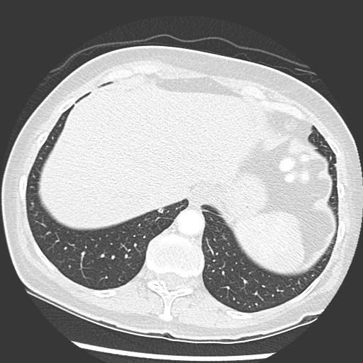 Amyloidosis - bronchial and diffuse nodular pulmonary involvement (Radiopaedia 60156-67745 Axial lung window 73).jpg