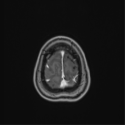 Anaplastic astroblastoma (Radiopaedia 55666-62194 Axial T1 C+ 69).png