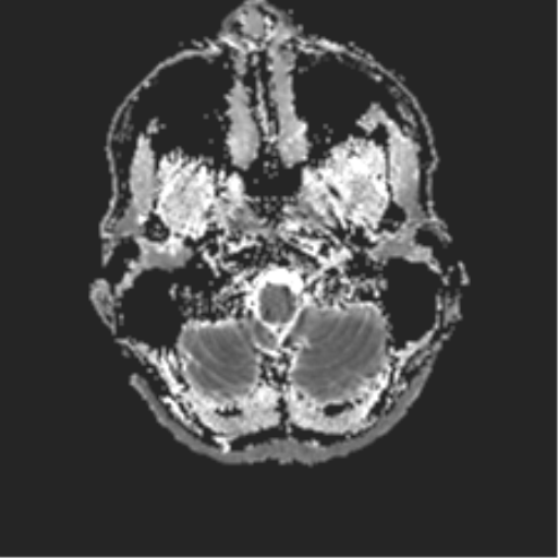 File:Anaplastic astrocytoma IDH mutant (Radiopaedia 50046-55341 Axial ADC 3).png