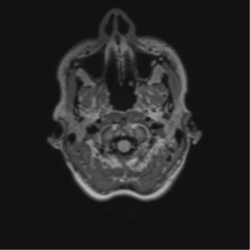 File:Anaplastic astrocytoma IDH mutant (Radiopaedia 50046-55341 Axial FLAIR 4).png