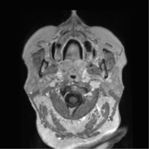Anaplastic astrocytoma IDH wild-type (pseudoprogression) (Radiopaedia 42209-45278 Axial T1 C+ 6).png