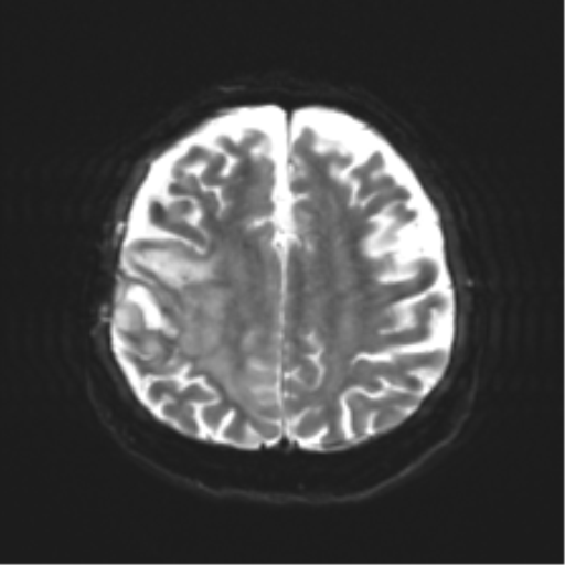 Anaplastic astrocytoma IDH wild-type (pseudoprogression) (Radiopaedia 42209-45279 Axial DWI 19).png