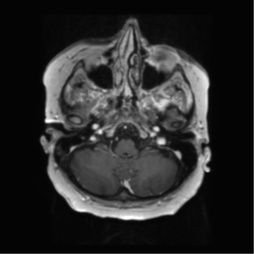 File:Anaplastic astrocytoma IDH wild-type (pseudoprogression) (Radiopaedia 42209-45279 Axial T1 C+ 30).png