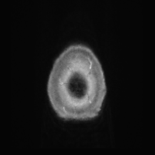 Anaplastic oligodendroglioma (Radiopaedia 83500-98599 Axial T1 C+ 76).png