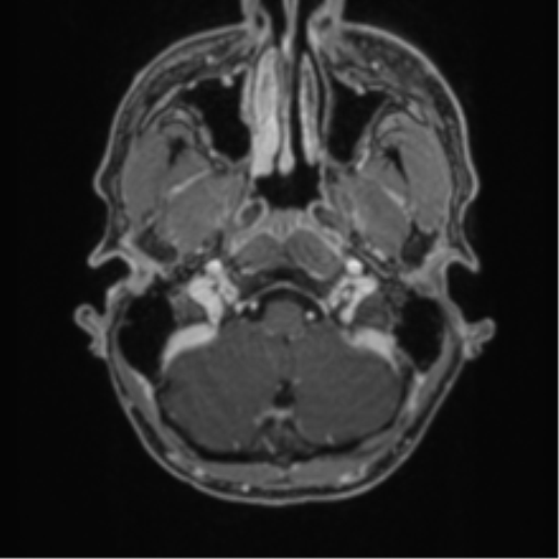 Anaplastic oligodendroglioma with skull fracture (Radiopaedia 74831-85845 Axial T1 C+ fat sat 2).png