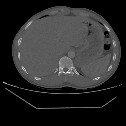 Aneurysmal bone cyst - rib (Radiopaedia 82167-96220 Axial bone window 228).jpg