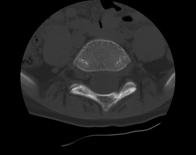 Aneurysmal bone cyst - sacrum (Radiopaedia 65190-74195 Axial bone window 11).jpg