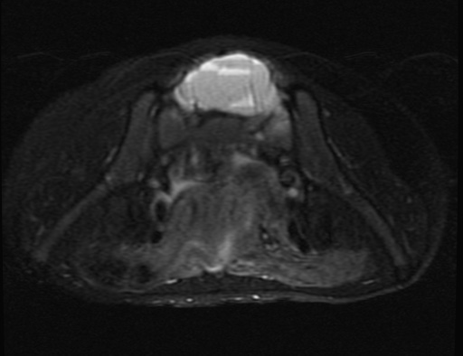 File:Aneurysmal bone cyst - sacrum (Radiopaedia 65190-74196 Axial T2 fat sat 9).jpg