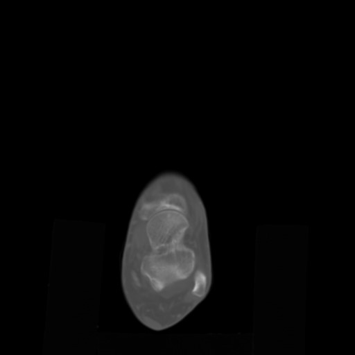 File:Aneurysmal bone cyst of the calcaneus (Radiopaedia 60669-68421 Axial bone window 2).jpg