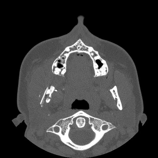 Aneurysmal bone cyst of the mandible (Radiopaedia 43280-46823 Axial bone window 92).jpg