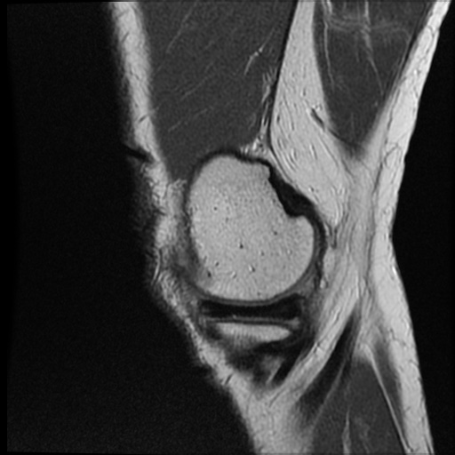 Anomalous insertion of the medial meniscus (Radiopaedia 77559-89721 Sagittal PD 44).jpg
