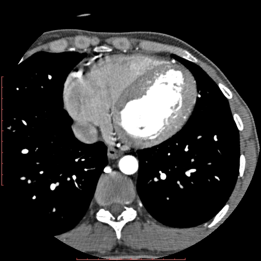 Anomalous left coronary artery from the pulmonary artery (ALCAPA) (Radiopaedia 70148-80181 A 265).jpg
