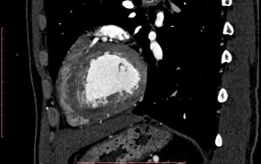 File:Anomalous left coronary artery from the pulmonary artery (ALCAPA) (Radiopaedia 70148-80181 C 181).jpg