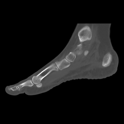 File:Anterior calcaneal process fracture (Radiopaedia 82590-96762 Sagittal bone window 8).jpg