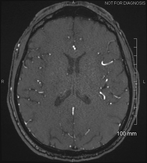 Anterior cerebral artery aneurysm (Radiopaedia 80683-94127 Axial MRA 146).jpg