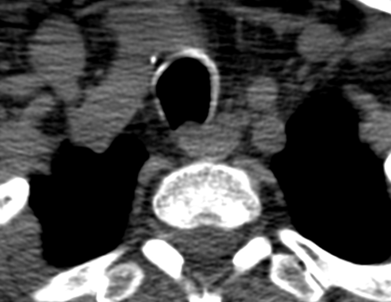 Anterior cervical postdiscectomy arthrodesis (Radiopaedia 32678-33646 Axial non-contrast 71).jpg