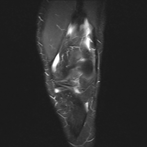 File:Anterior cruciate ligament full thickness tear (Radiopaedia 66268-75467 Coronal STIR 5).jpg