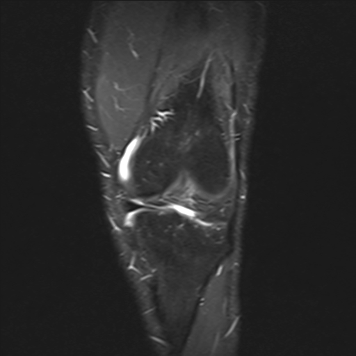 File:Anterior cruciate ligament full thickness tear (Radiopaedia 66268-75467 Coronal STIR 6).jpg