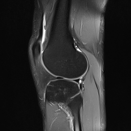File:Anterior cruciate ligament full thickness tear (Radiopaedia 66268-75467 Sagittal PD fat sat 18).jpg