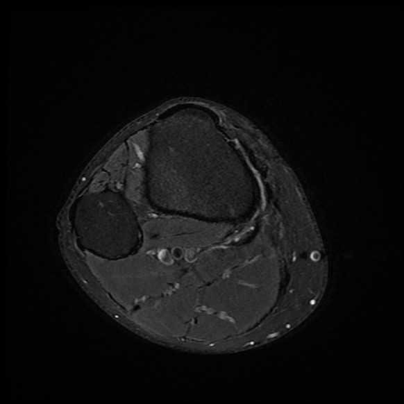 File:Anterior cruciate ligament graft tear and bucket-handle tear of medial meniscus (Radiopaedia 75867-87254 Axial PD fat sat 1).jpg