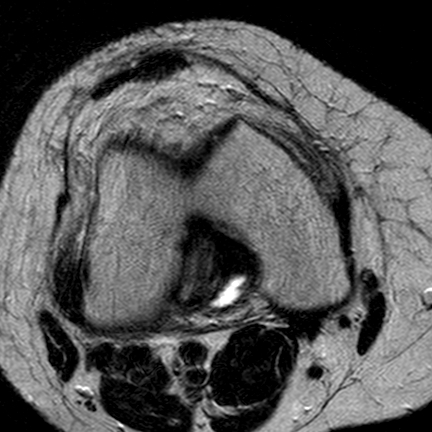 File:Anterior cruciate ligament mucoid degeneration (Radiopaedia 60853-68633 Axial T2 16).jpg
