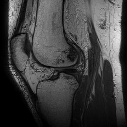 Anterior cruciate ligament rupture with Segond fracture (Radiopaedia 69043-78806 Sagittal PD 107).jpg