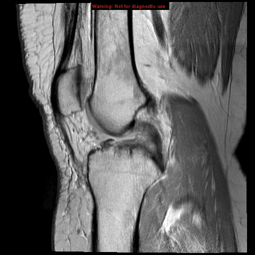 File:Anterior cruciate ligament tear (Radiopaedia 12329-12612 Sagittal T2 fat sat 11).jpg