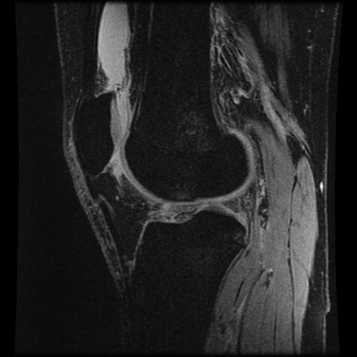 Anterior cruciate ligament tear (Radiopaedia 61500-69462 F 55).jpg