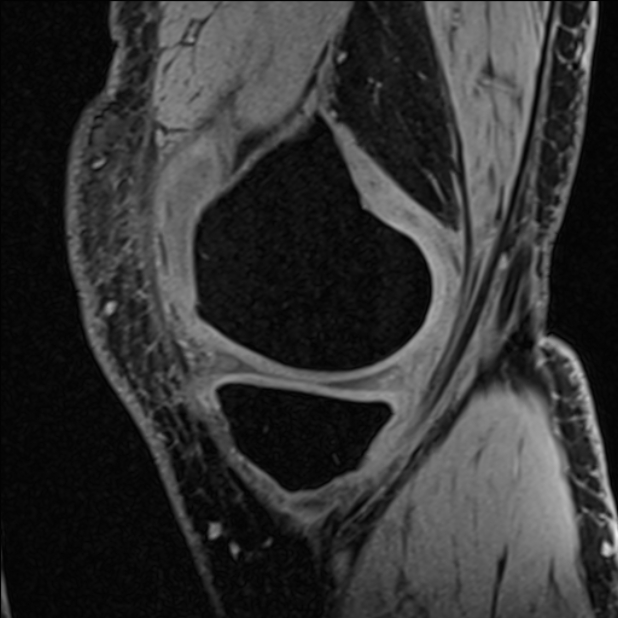 Anterior cruciate ligament tear - ramp lesion (Radiopaedia 71883-82322 Sagittal T1 vibe 107).jpg