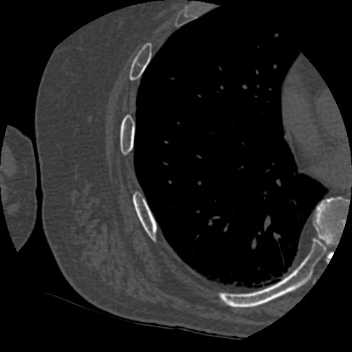File:Anterior glenohumeral dislocation with Hill-Sachs lesion (Radiopaedia 62877-71249 Axial bone window 117).jpg