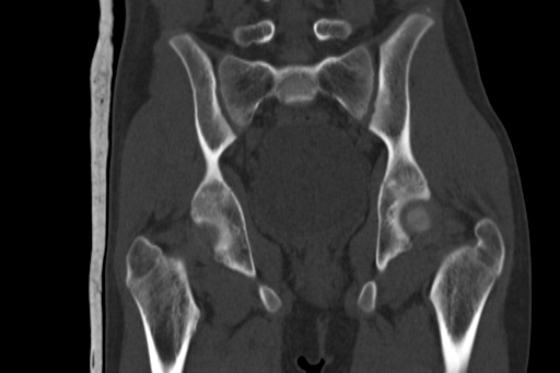Anterior inferior iliac spine avulsion injury (Radiopaedia 88666-105376 Coronal bone window 44).jpg