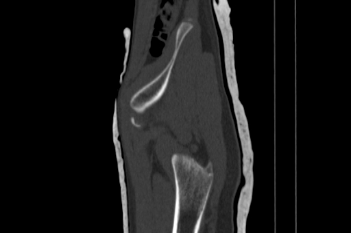 Anterior inferior iliac spine avulsion injury (Radiopaedia 88666-105376 Sagittal bone window 19).jpg